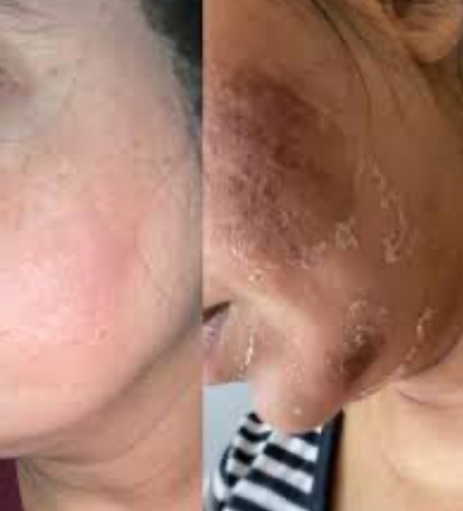 DR Enzyme Treatment