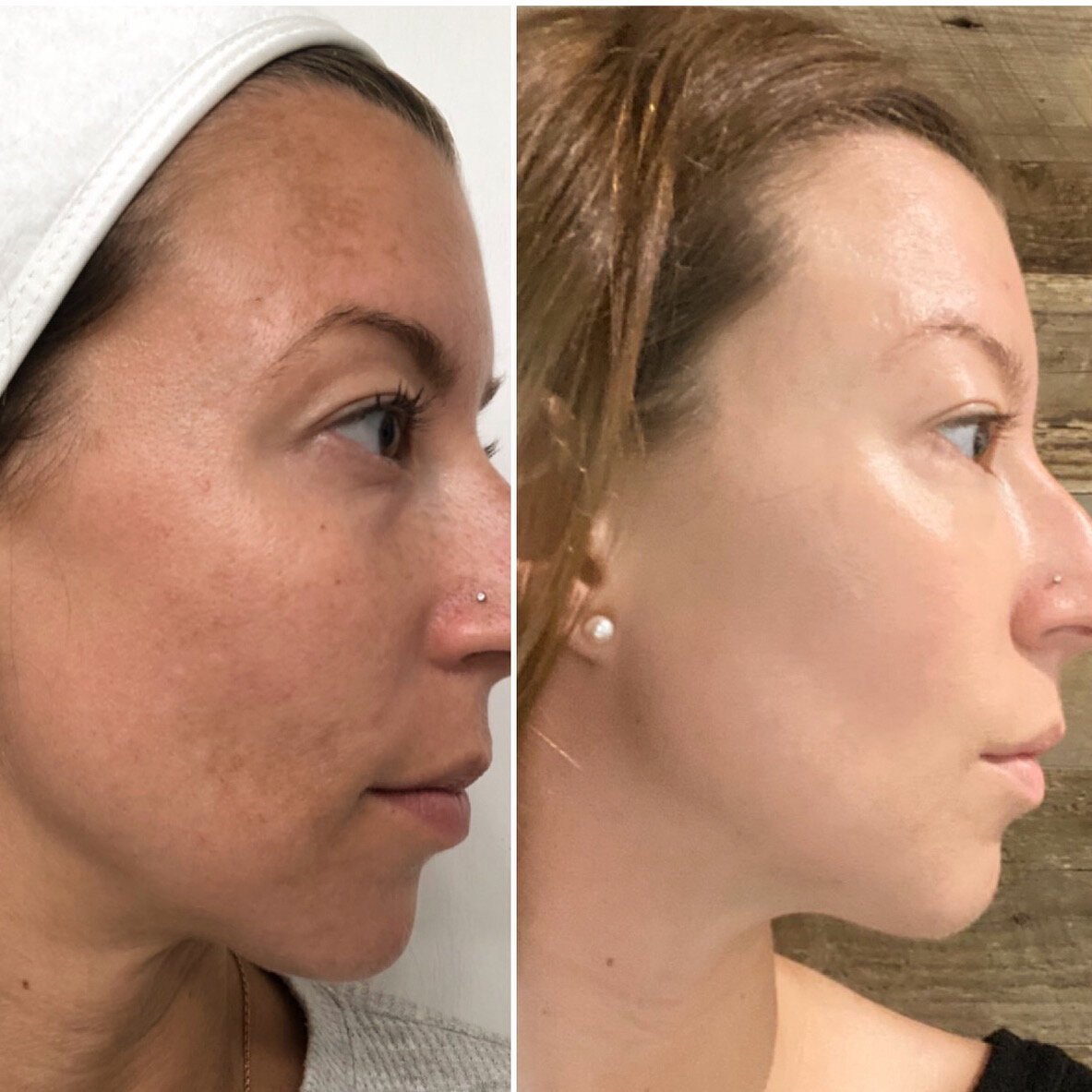 Deep Facial + Derma Peel at Vitaly Beauty Secret in Miramar, FL