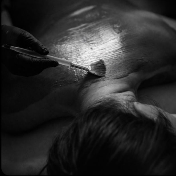 Back Treatment at Estelle Esthetics in Tunnel Hill, GA