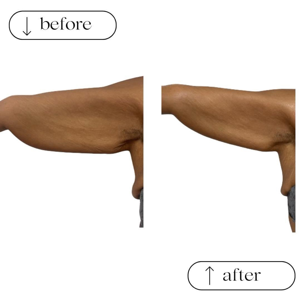 RF Skin Tightening