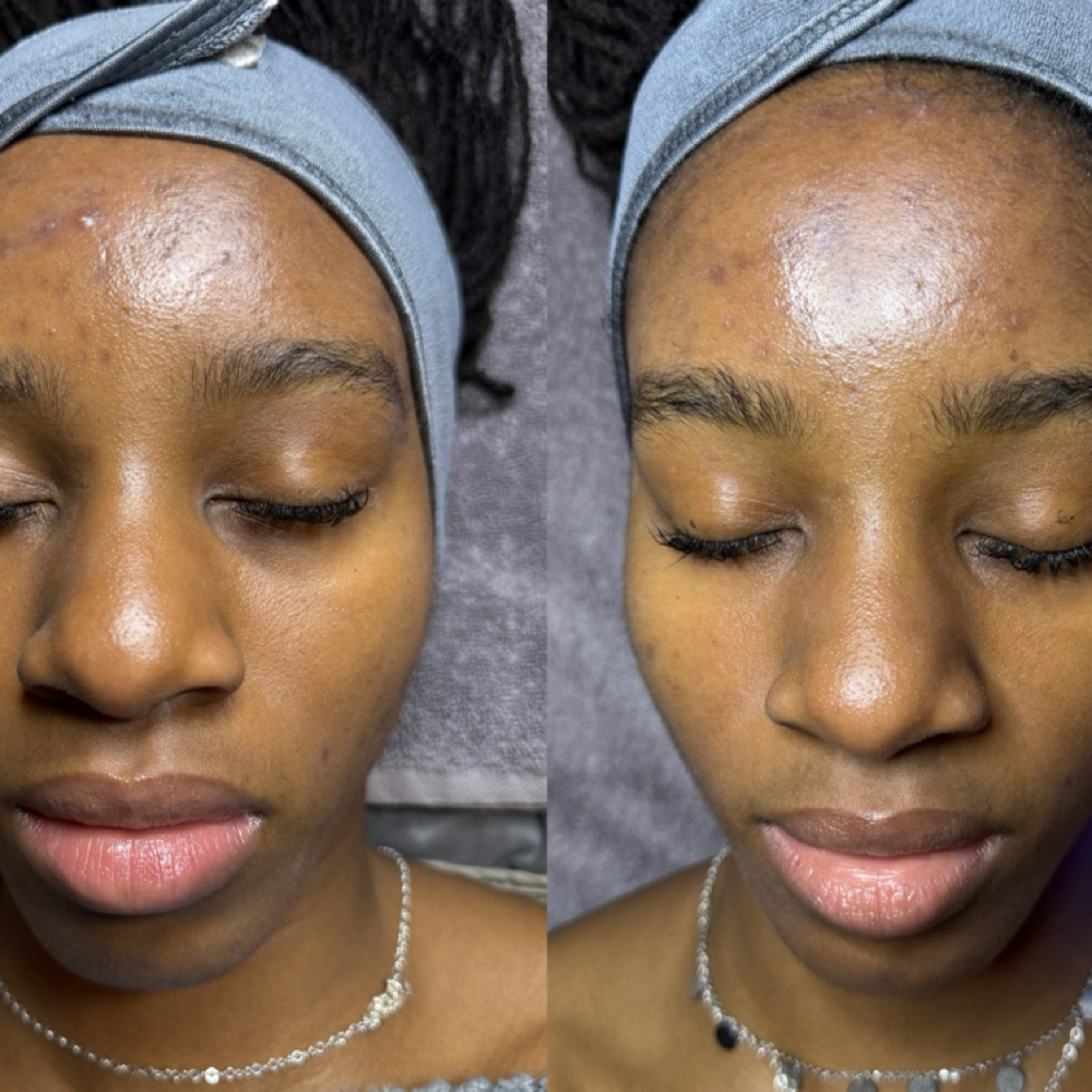 VI Peel + Peptides Package 1 at Oasiah Aesthetics in New York, NY