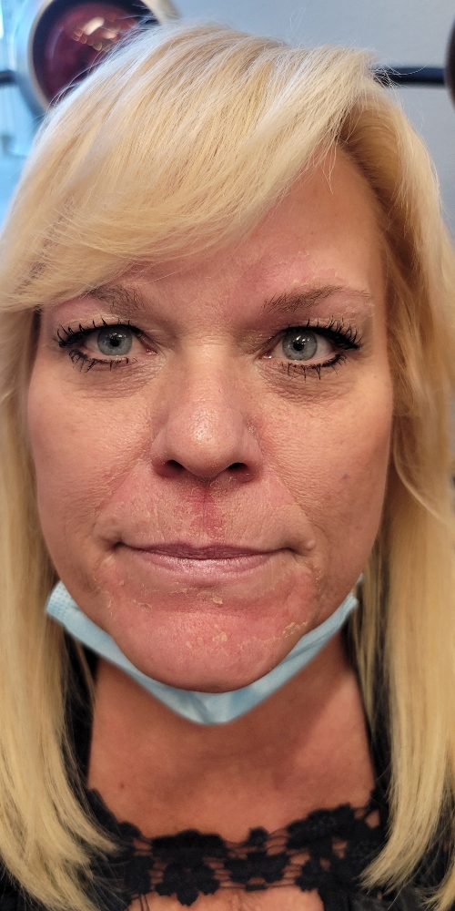 Moderate Peel