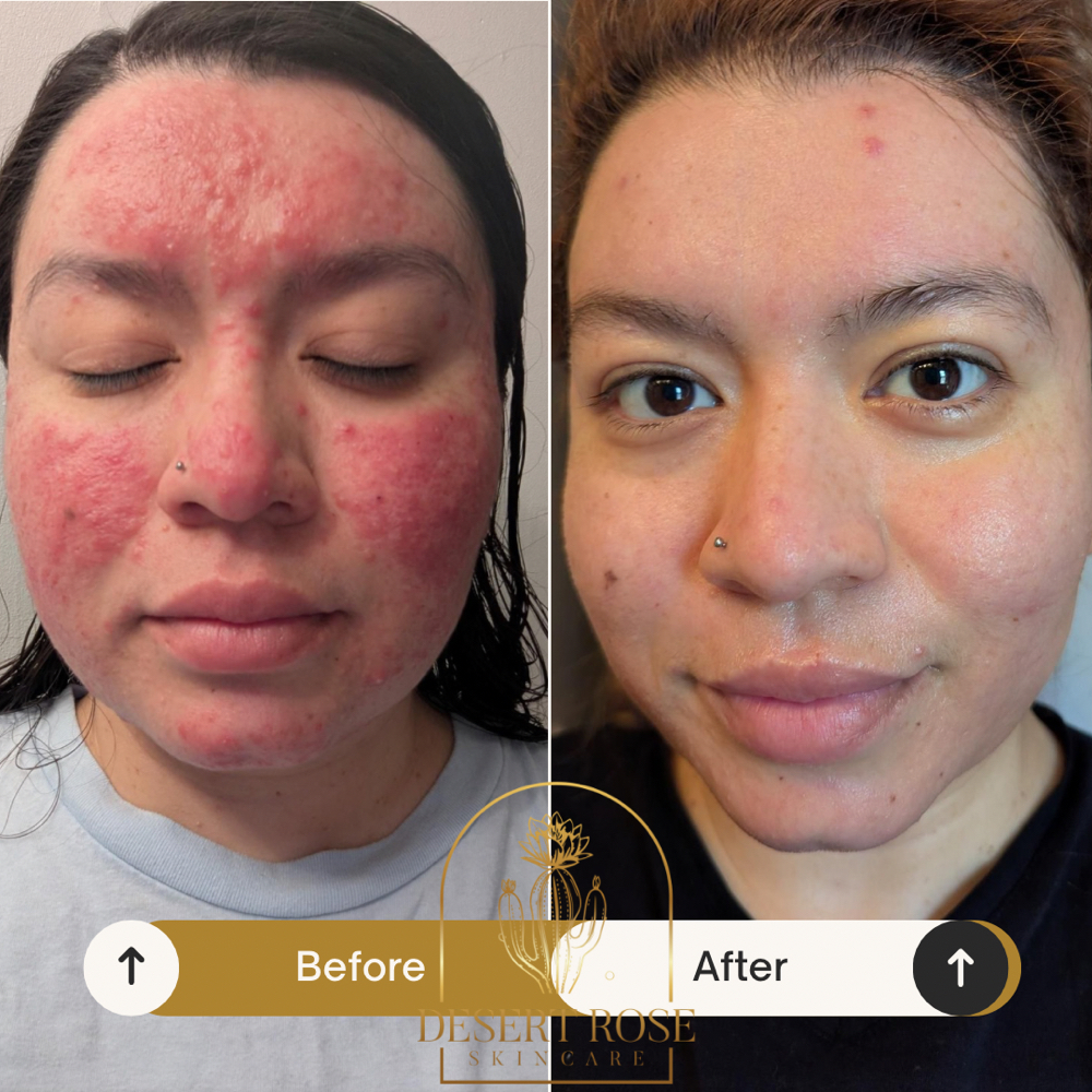 Virtual Skin Consultation at Desert Rose Skincare in Rio Rancho, NM