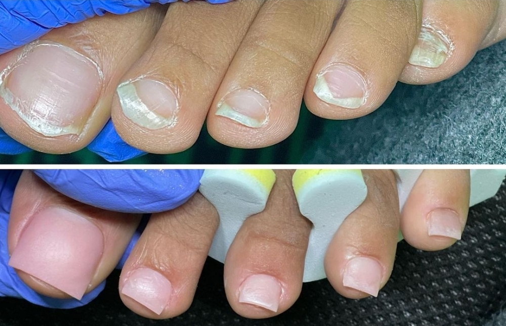 Toenail Enhancements