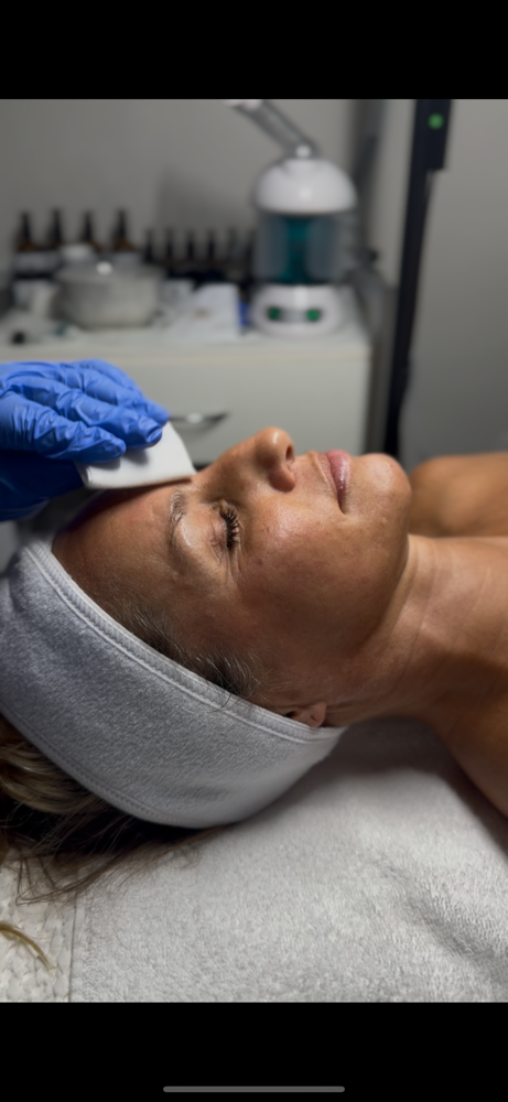 TCA Chemical Peel