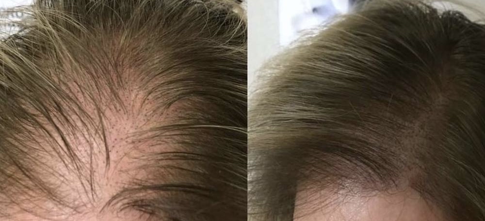 Scalp Micropigmentation