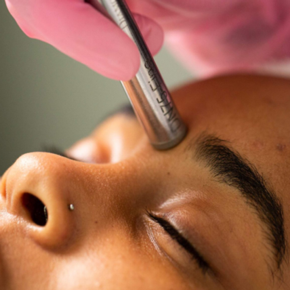 Microdermabrasion