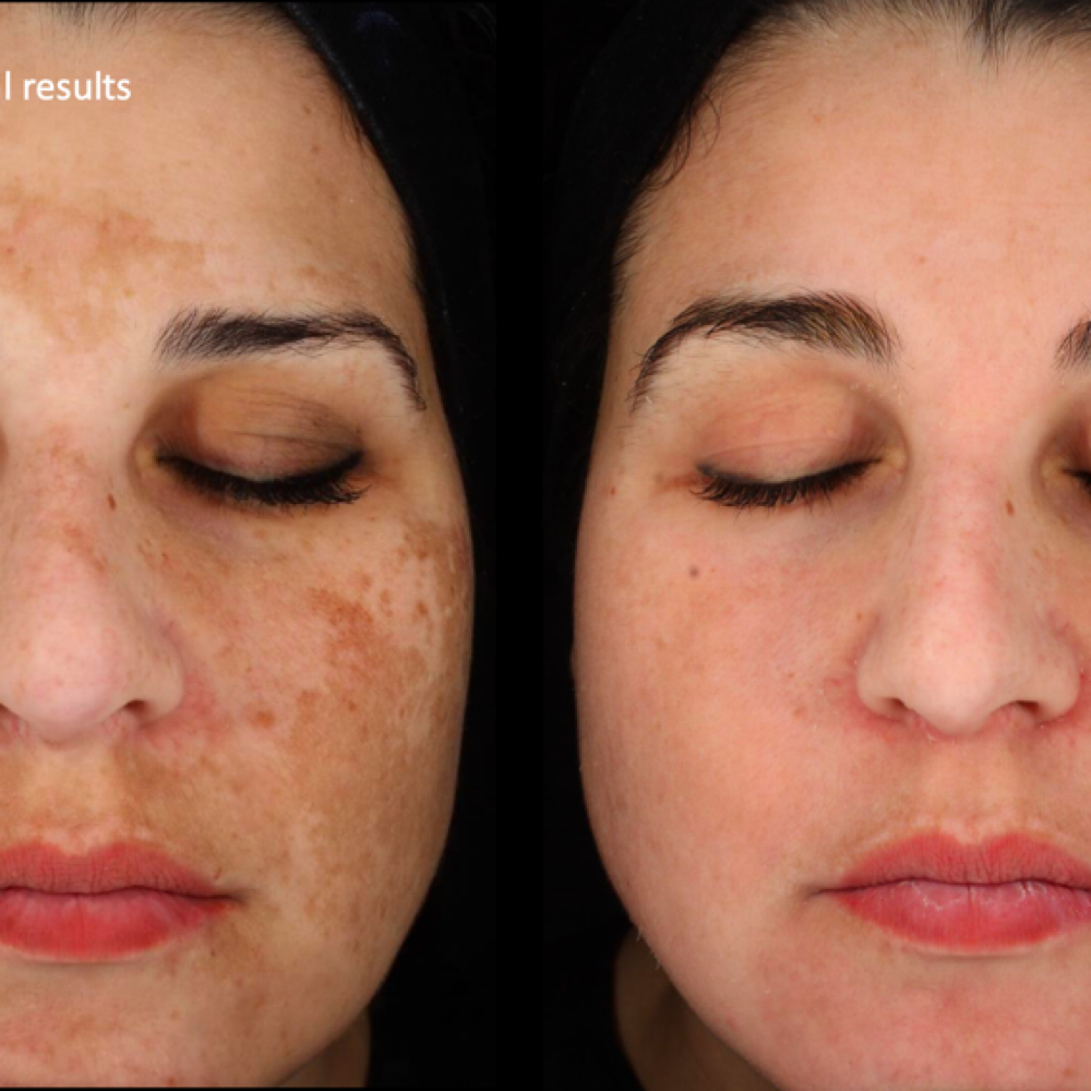 Cosmelan Peel (3 Months Treatment) at Irena Studio & Academy in McAllen, TX