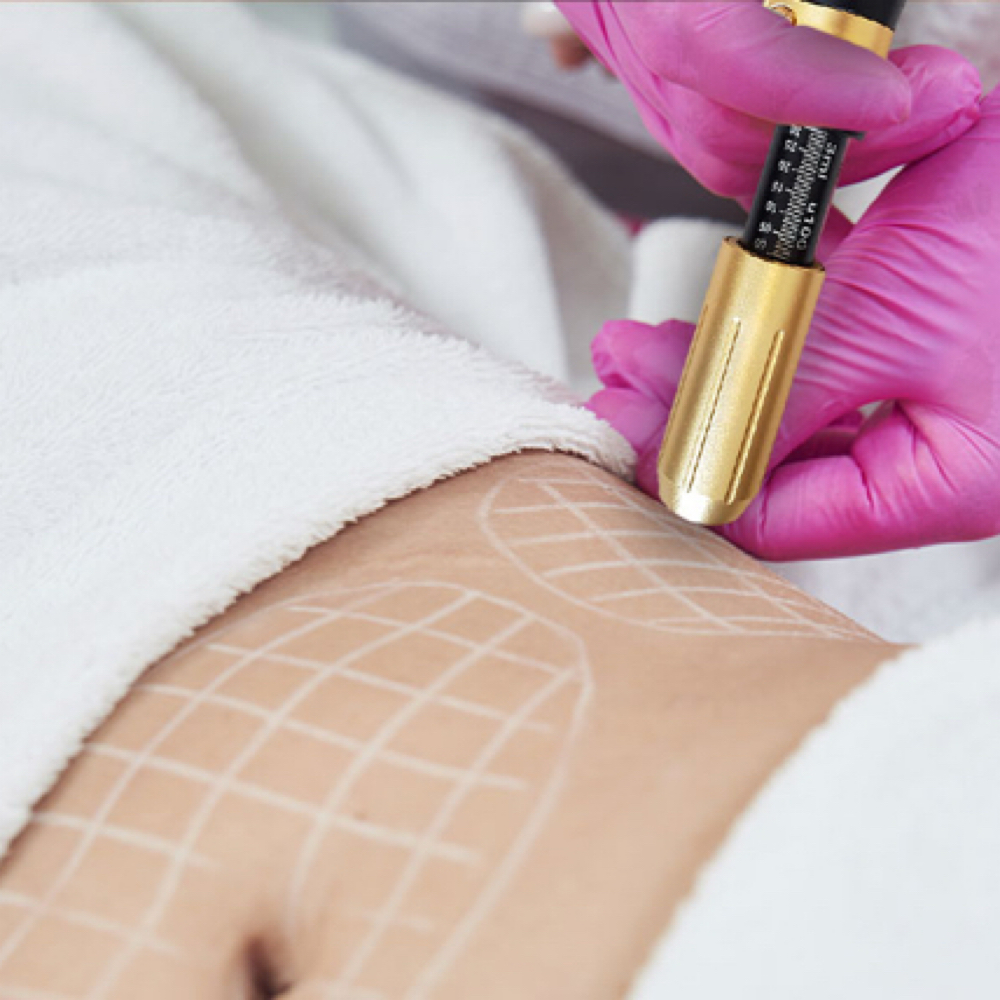 Needle-Free Fat Dissolve Injections at Bayou Glow, LLC in Larose, LA