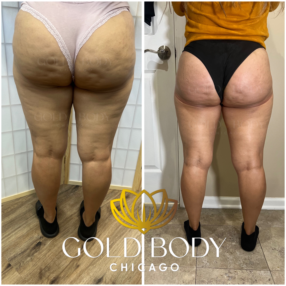 Cellulite Treatment Back Only