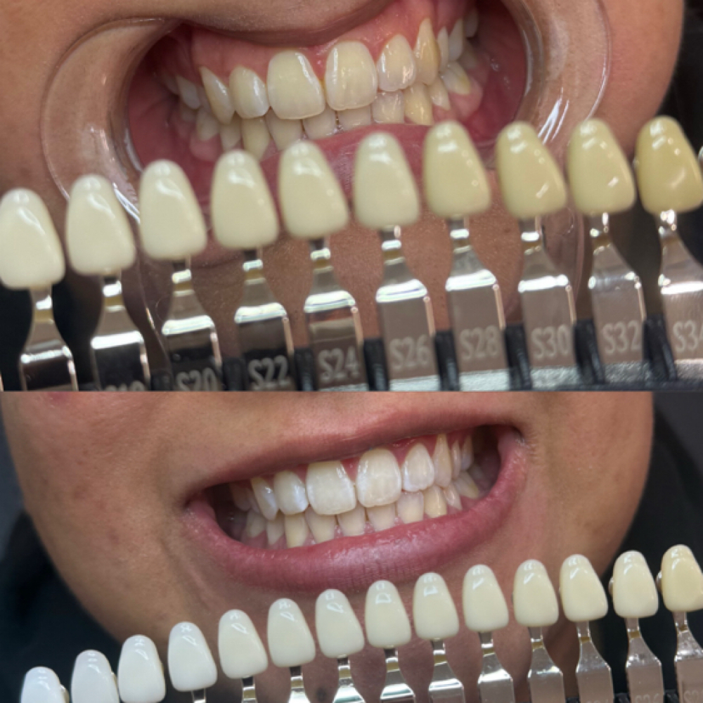 Teeth Whitening at Chic Claws in Chicago, IL