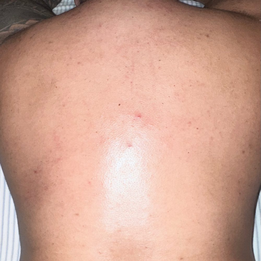 Back Facial at Kay Skin Studio in Northampton, PA