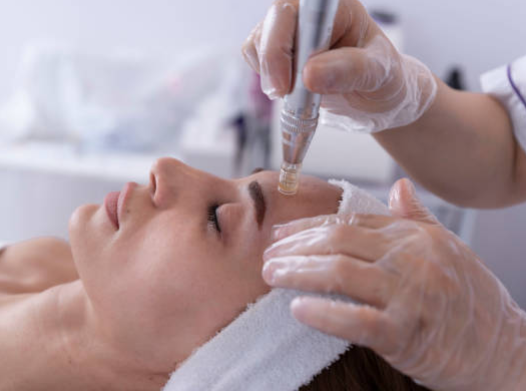 Microneedling