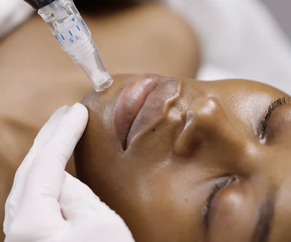 Deluxe Microneedling Facial
