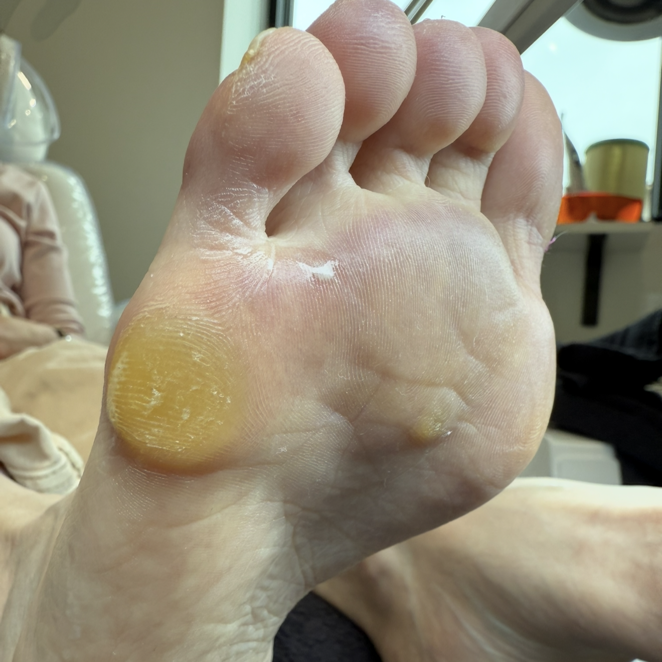 Foot Skin Care (Localized Area)