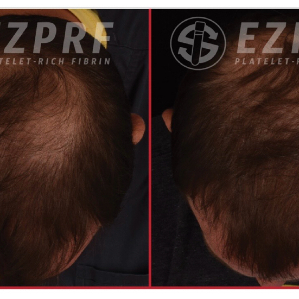 PRP For Hair Loss at Beauty Dare Aesthetics PLLC in Laredo, TX