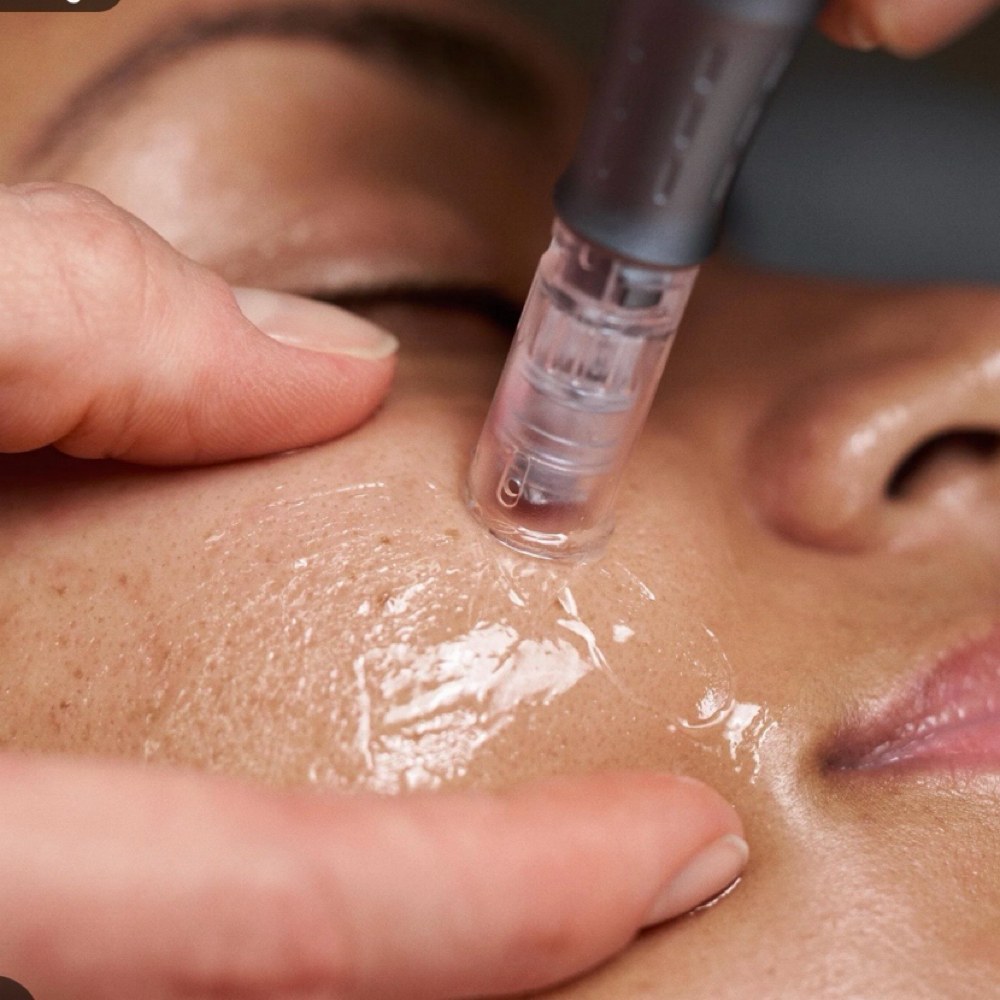 Nano needling With Facial at Fresh Face Spa in San Diego, CA