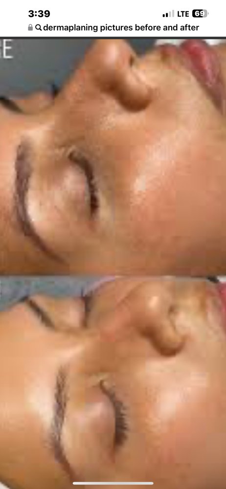 Dermaplane