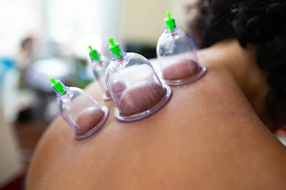CUPPING (ONE AREA)