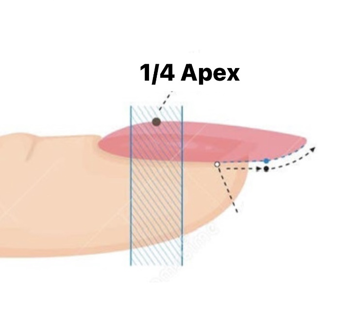 structure gel fill-in (1/4 apex)