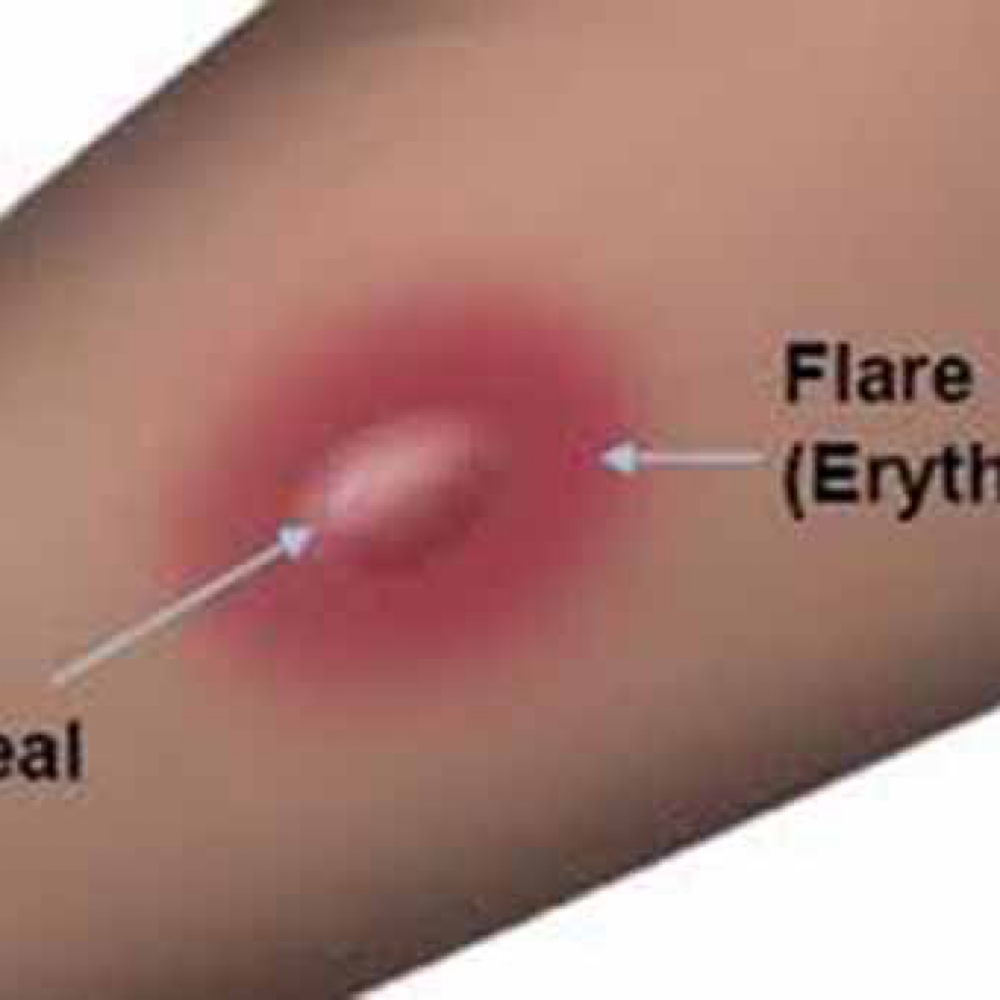 Patch Test For Allergies at Hunny Bunny Lashes in Spring Hill, FL