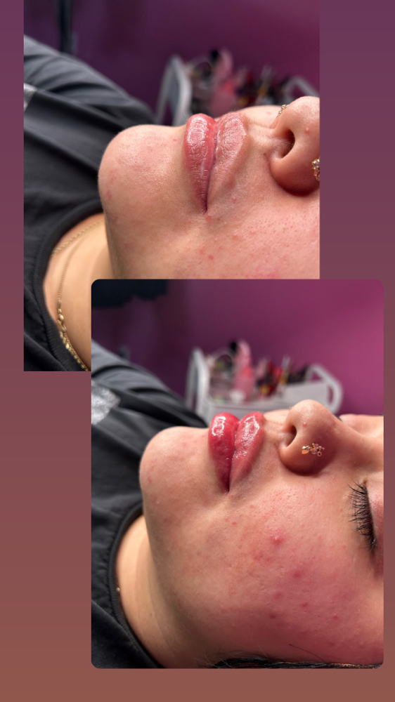 0.5 Ml Lips