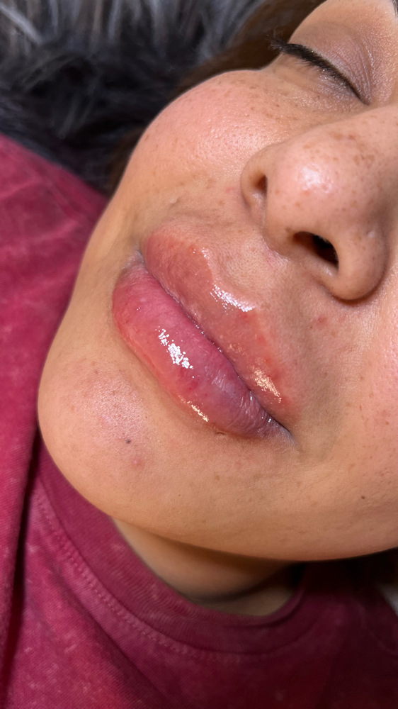 1ml Hyaluronic Acid Lip Filler