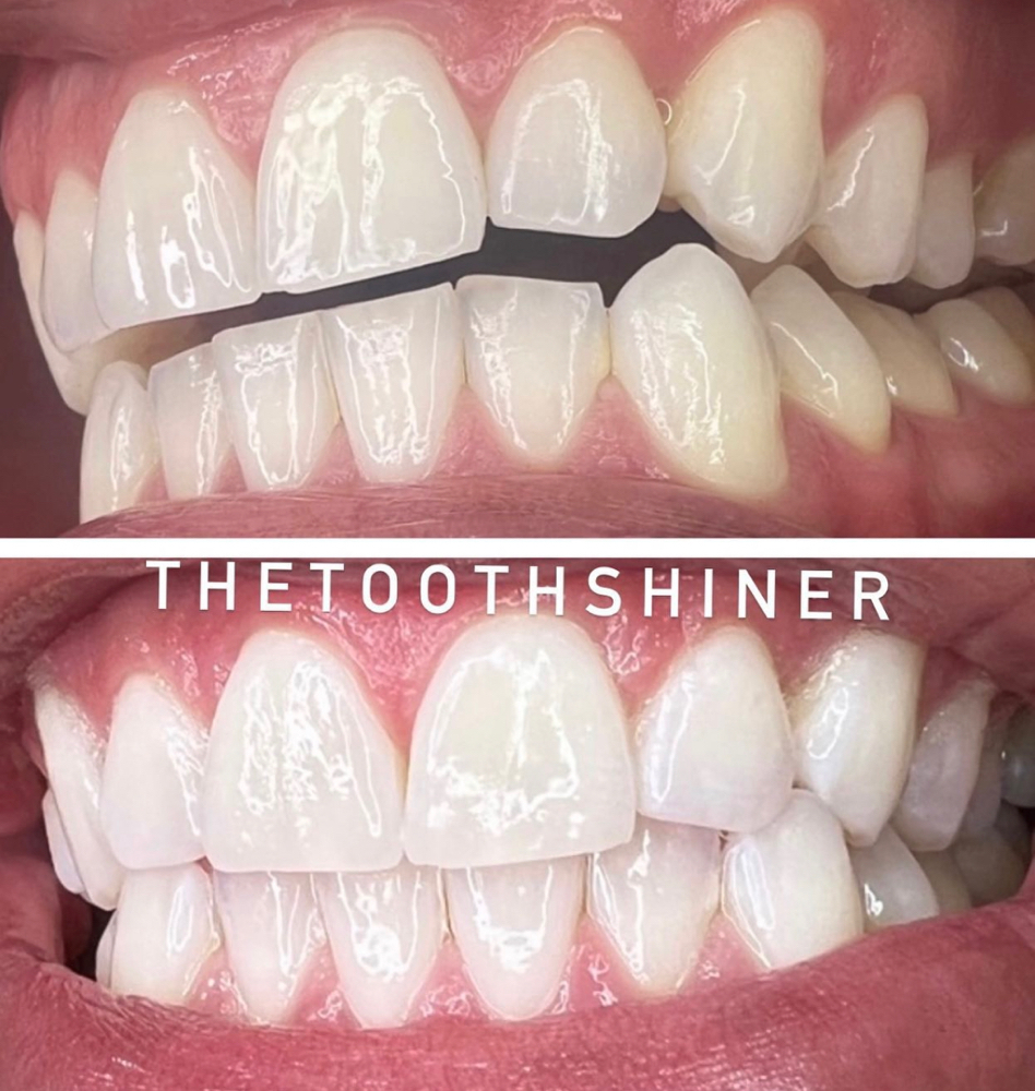 (Touch Up)1HOUR Pro Laser Whitening
