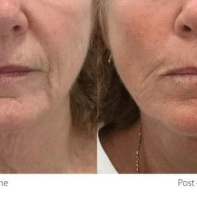Opus Resurfacing Face at The Laser Collective in Gilbert, AZ