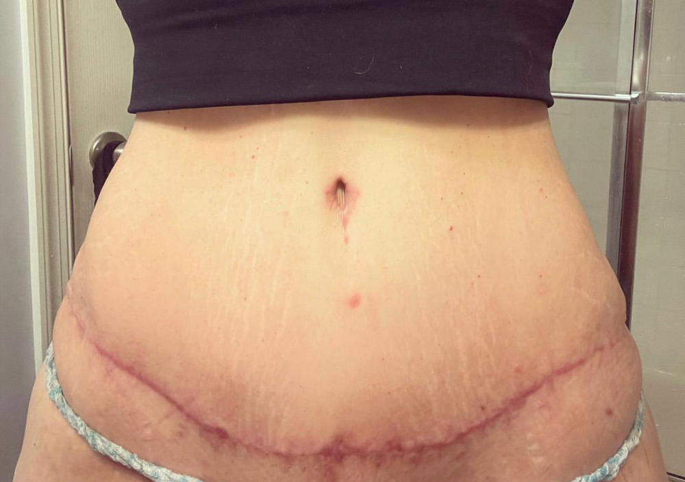 Tummy Tuck Scar at Ideal Ink Lab in Miami, FL