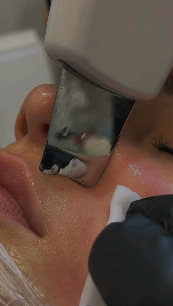Extracciones Facial