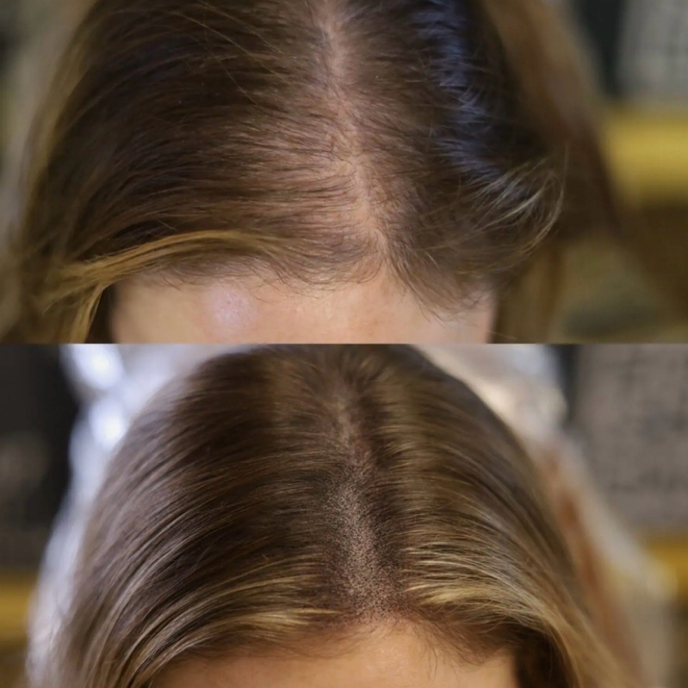 Womens Scalp Micropigmentation at Rewind Med Spa in Longmont, CO