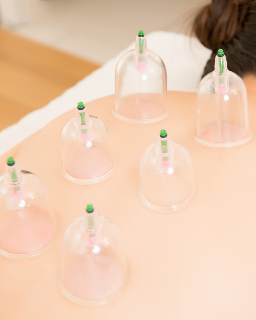 Holistic Cupping Therapy