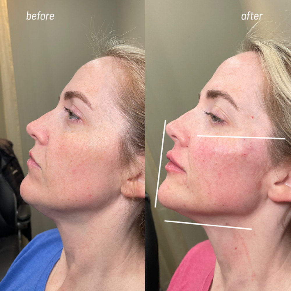 Facial Balancing at Safe Haven MedSpa in McAllen, TX