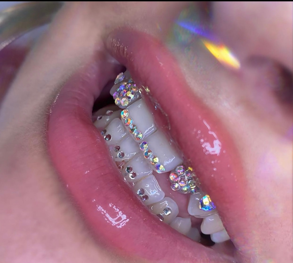 Full Mouth Of Tooth Gems