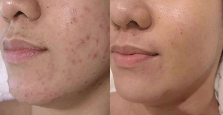 Acne Control