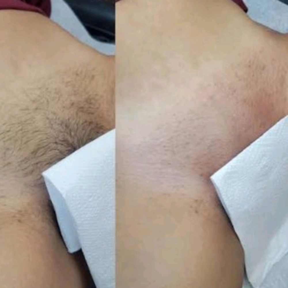 Brazilian at Merritt Aesthetics in Rochester, NY