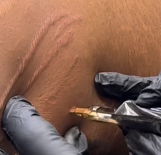 Stretch mark - Camouflage Tattooing