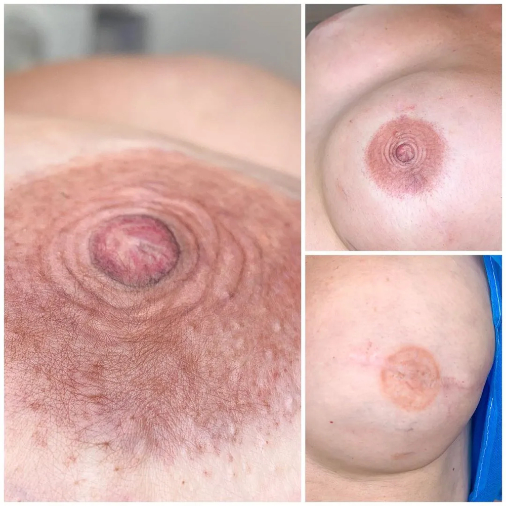 3D Mastectomy Areola