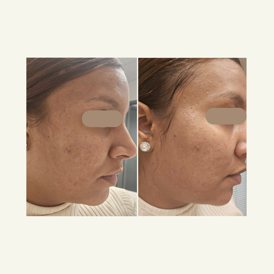 Chemical Peels (Requires Consult)