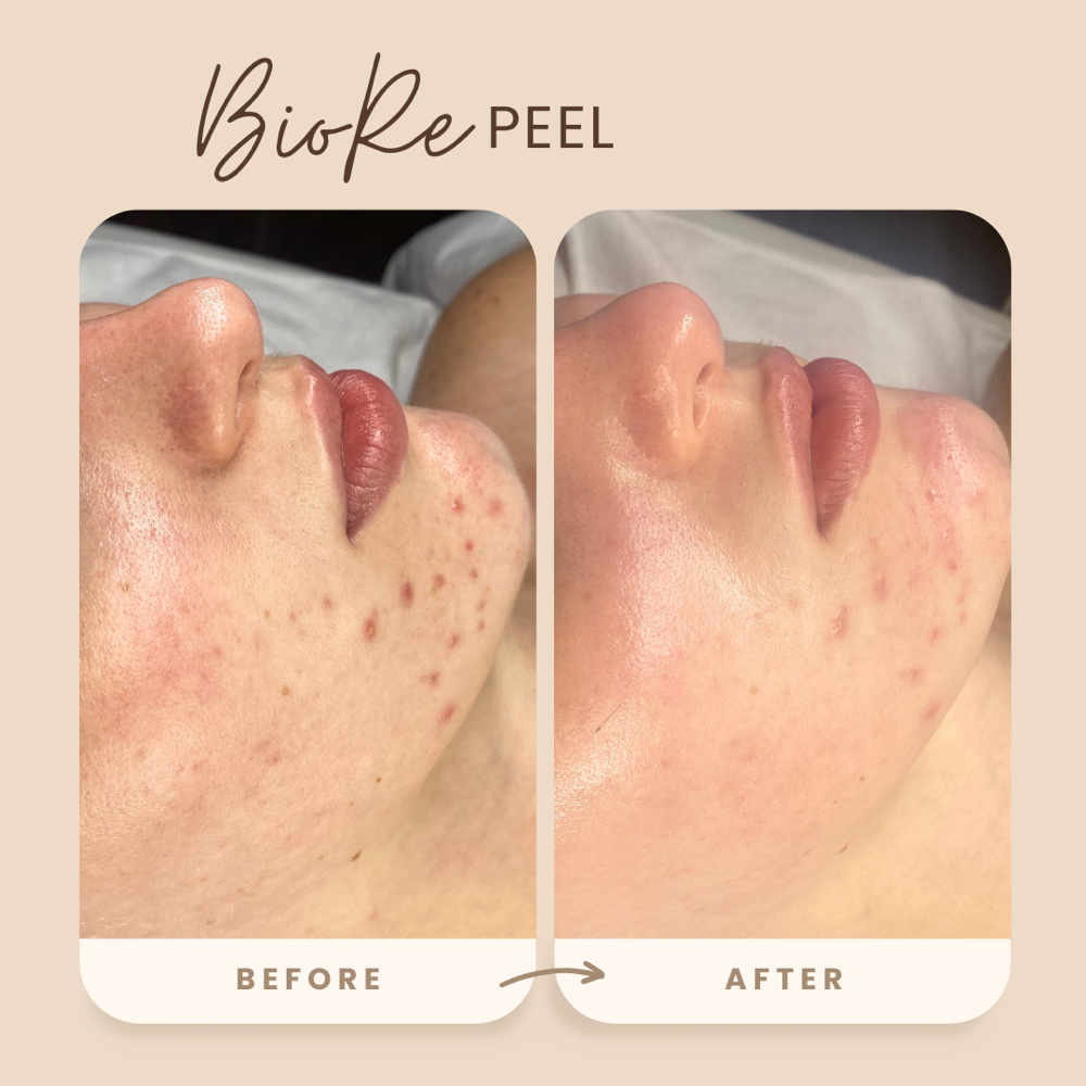 BioRe Peel