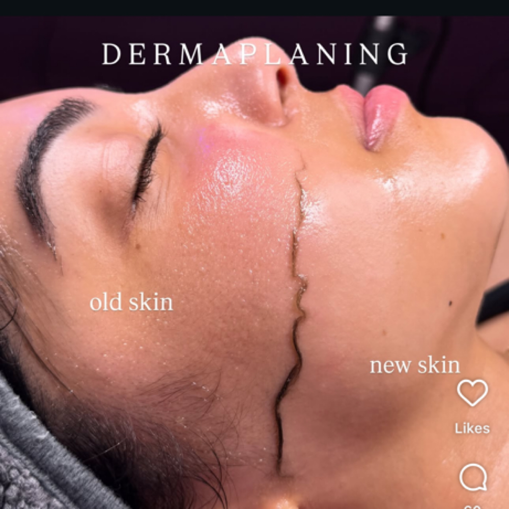 Dermaplaning