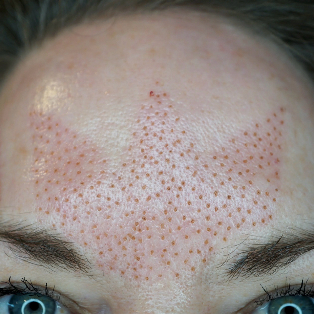 Plasma Treatment at B&G by Tania Loiola in Celebration, FL