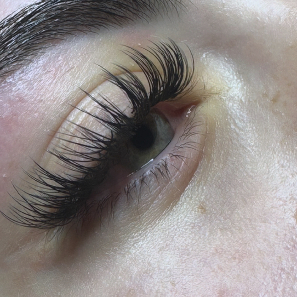 Custom Fill at Zen Esthetics in Greensburg, PA