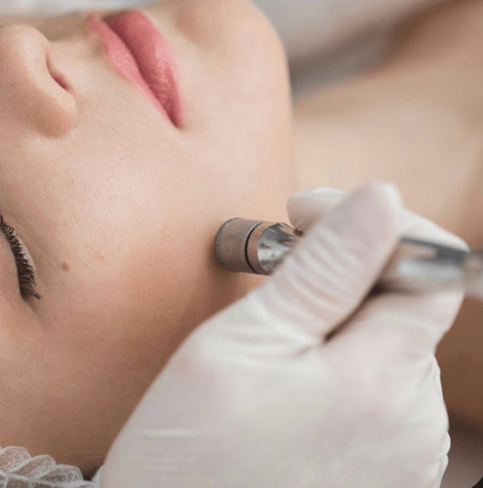 ‘Just’ Microdermabrasion