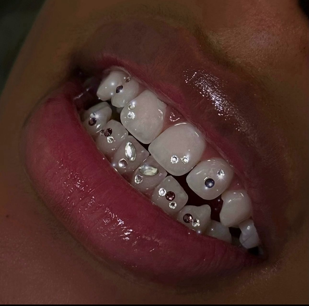 Additional tooth gems
