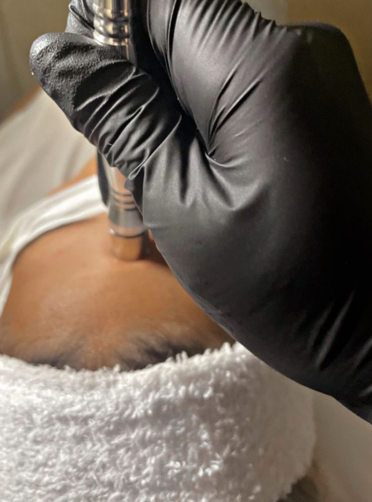 Microdermabrasion Facial