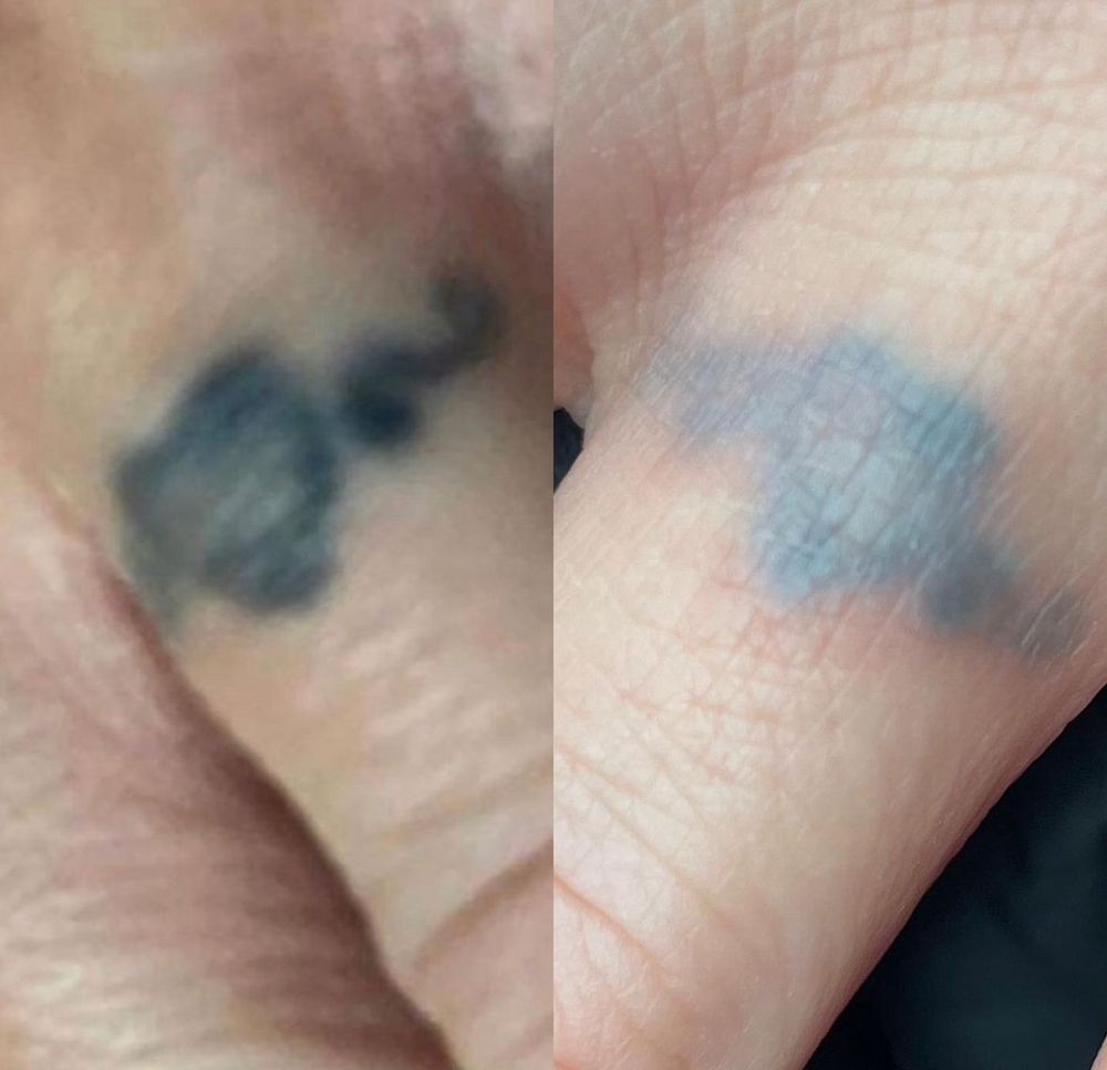 Tattoo Removal/Lightening