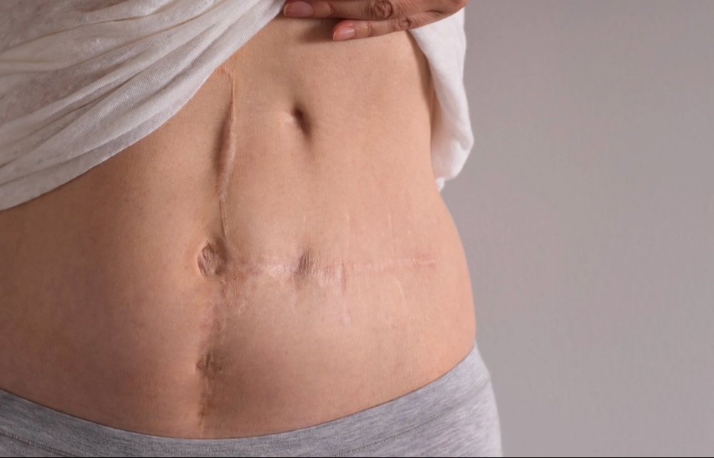 Scar Renewal and Restoration