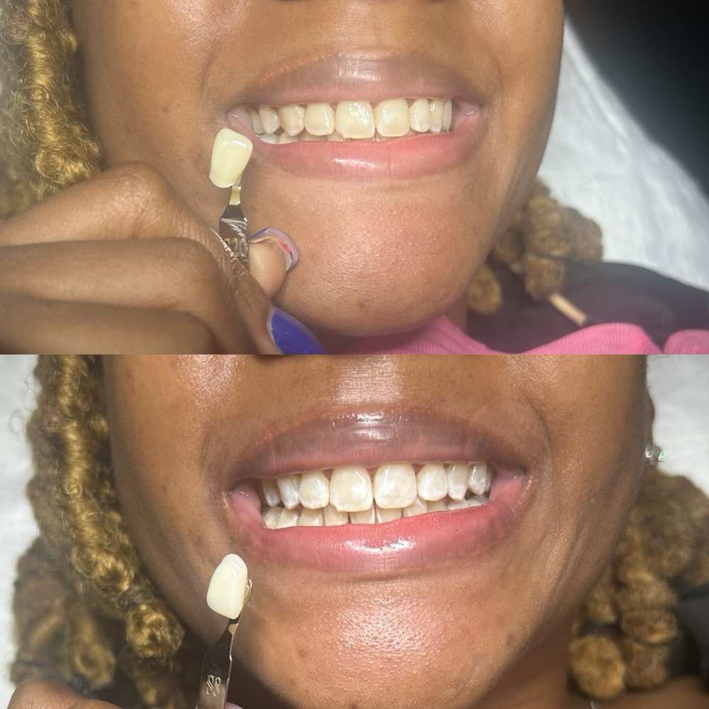 30 Min Teeth Whitening at HVS BODY in Shaker Hts, OH